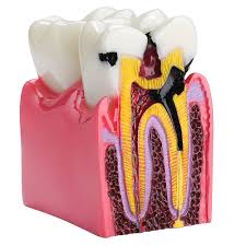 Tooth Decay Model