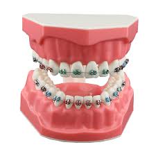 Orthodontic Braces Model