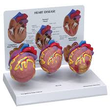 Diseased Heart Model
